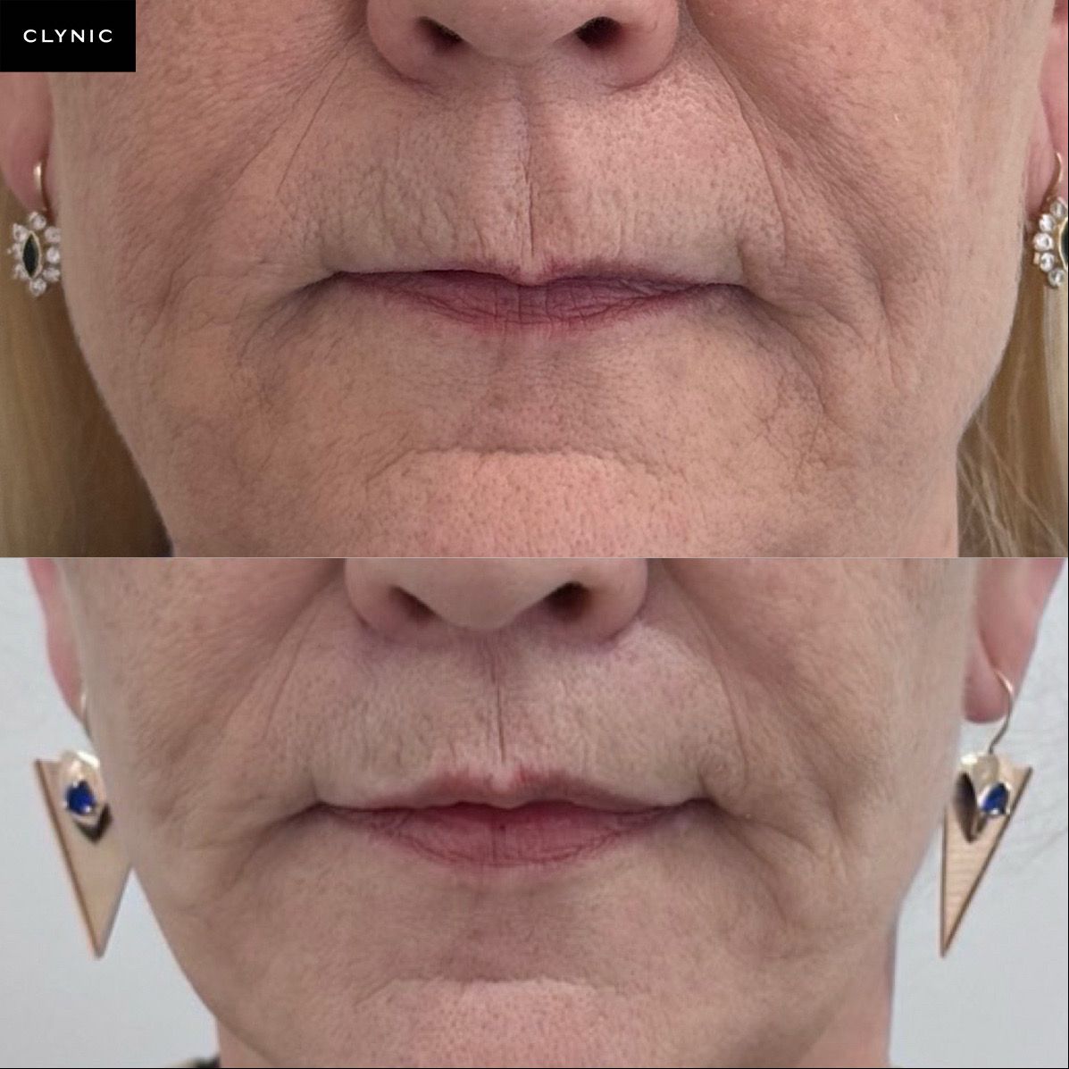 Lip lift
